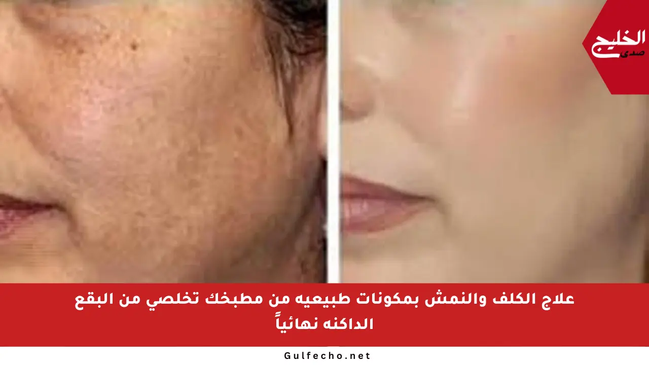 علاج الكلف والنمش بمكونات طبيعية من مطبخك تخلصي من البقع الداكنة نهائياً